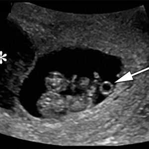 ultrasound-for-single-and-twin-pregnancies